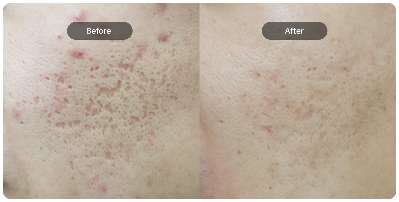 여드름 패인 흉터에 특화된 치료